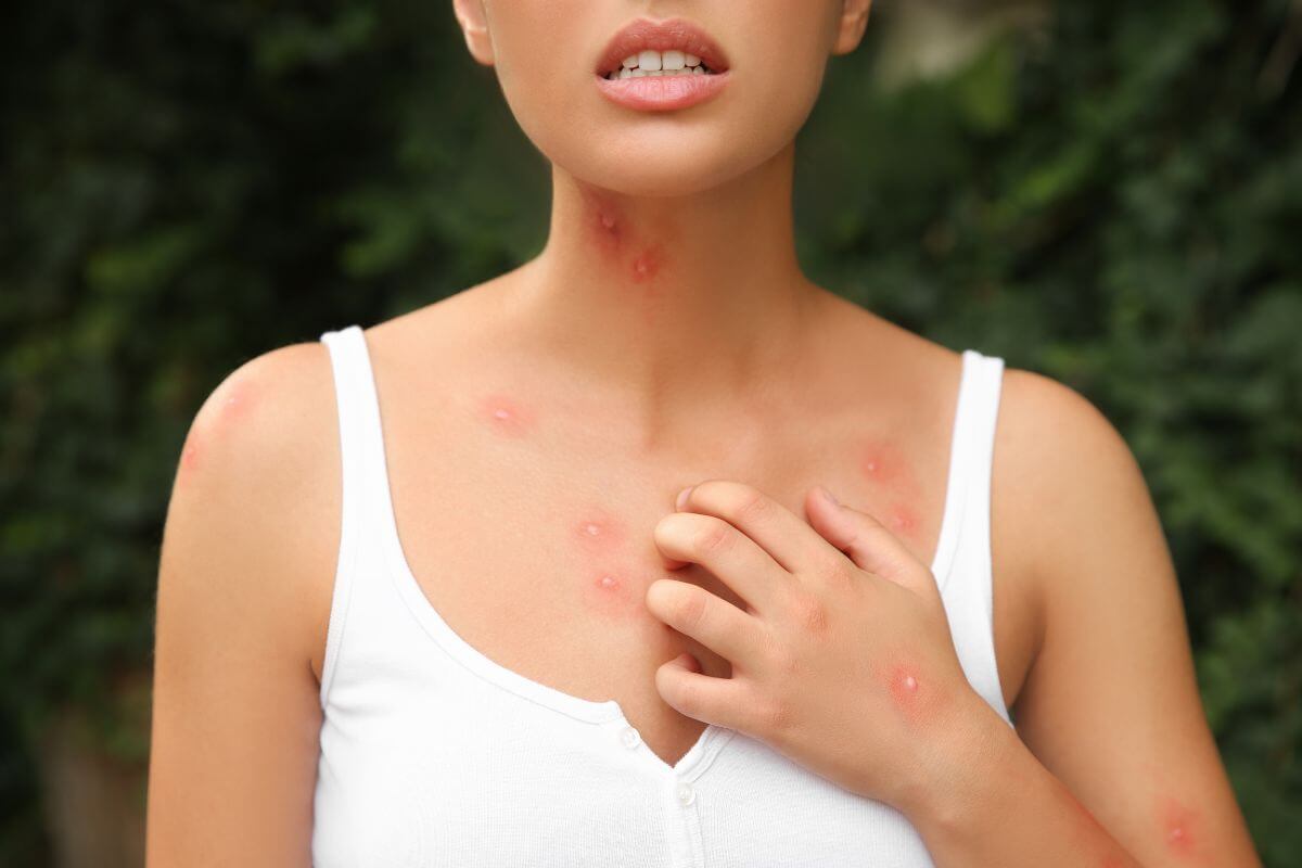 A woman with bug bites on her chest.